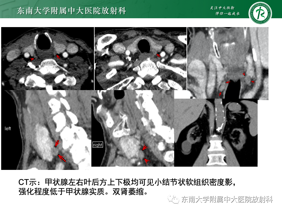 影像PPT - 【PPT】甲状旁腺病变-36