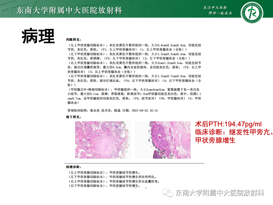 影像PPT - 【PPT】甲状旁腺病变-38