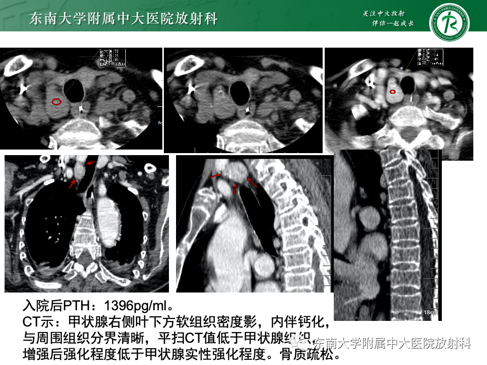 影像PPT - 【PPT】甲状旁腺病变-41