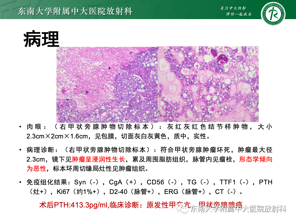 影像PPT - 【PPT】甲状旁腺病变-42