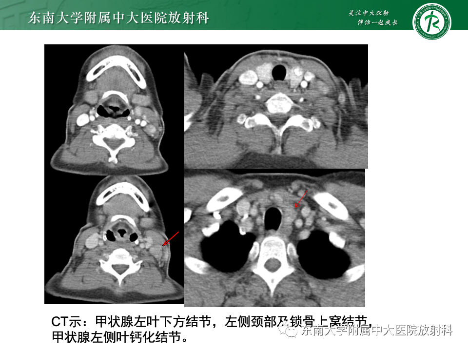 影像PPT - 【PPT】甲状旁腺病变-45