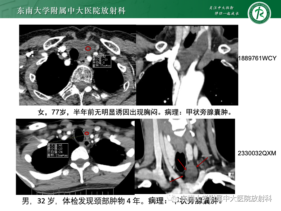 影像PPT - 【PPT】甲状旁腺病变-49