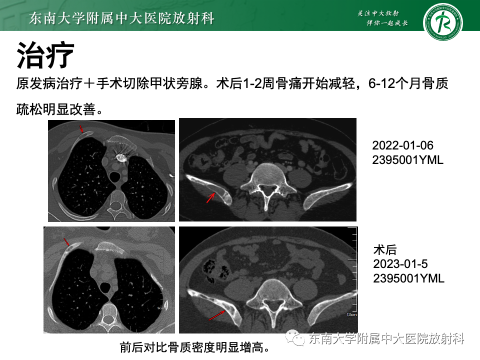 影像PPT - 【PPT】甲状旁腺病变-53
