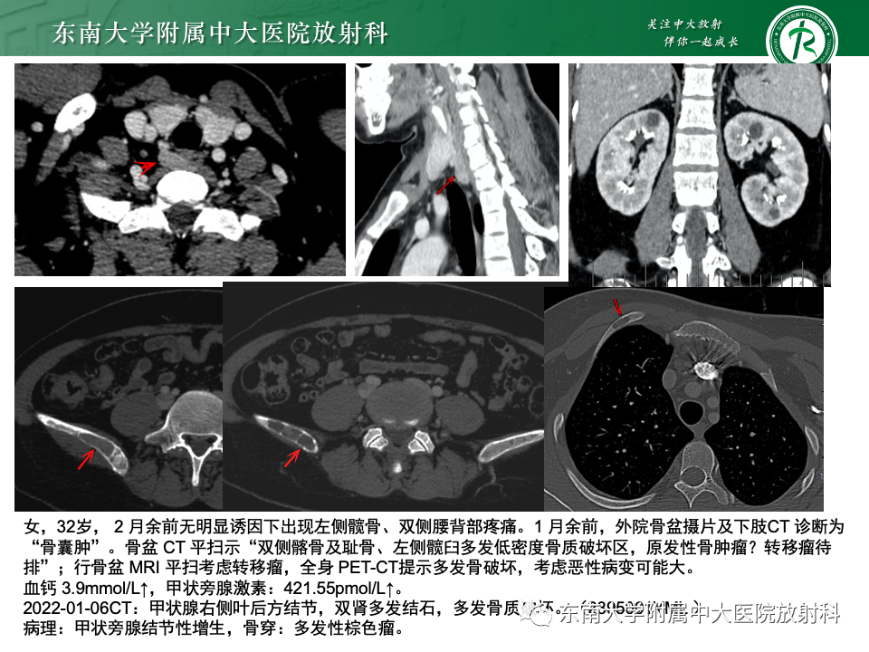 影像PPT - 【PPT】甲状旁腺病变-52