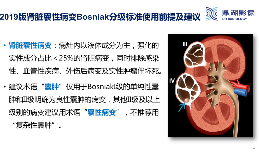 影像PPT - 【PPT】肾脏囊性病变Bosniak分级-4 影像PPT - 【PPT】肾脏囊性病变Bosniak分级-4