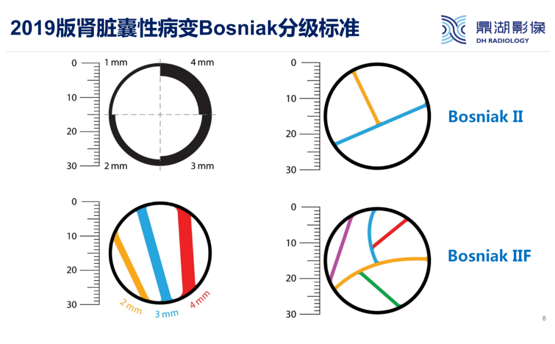 影像PPT - 【PPT】肾脏囊性病变Bosniak分级-8 影像PPT - 【PPT】肾脏囊性病变Bosniak分级-8