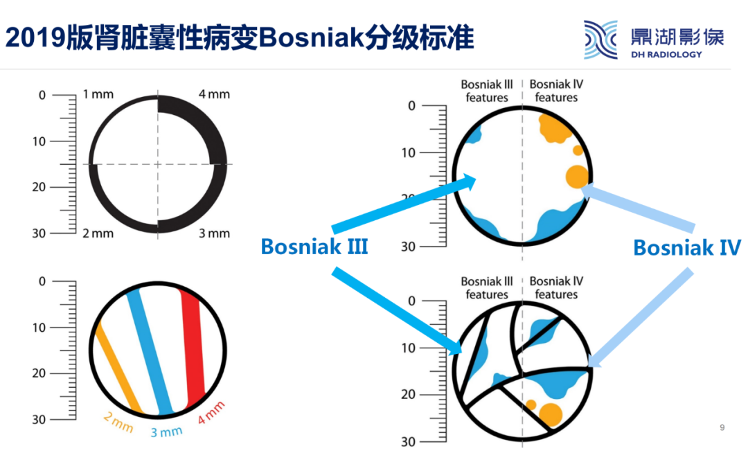 影像PPT - 【PPT】肾脏囊性病变Bosniak分级-9 影像PPT - 【PPT】肾脏囊性病变Bosniak分级-9