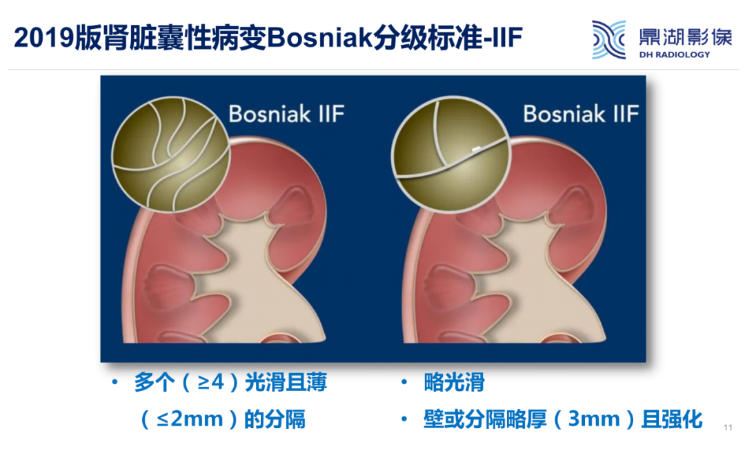 影像PPT - 【PPT】肾脏囊性病变Bosniak分级-11 影像PPT - 【PPT】肾脏囊性病变Bosniak分级-11