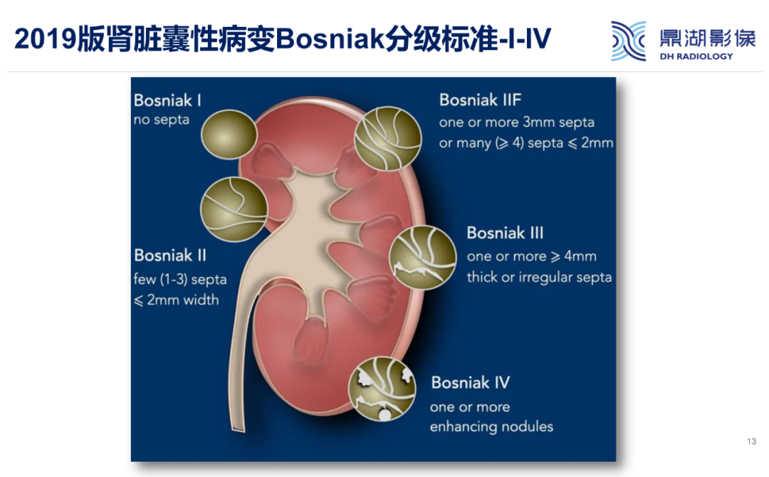 影像PPT - 【PPT】肾脏囊性病变Bosniak分级-13 影像PPT - 【PPT】肾脏囊性病变Bosniak分级-13