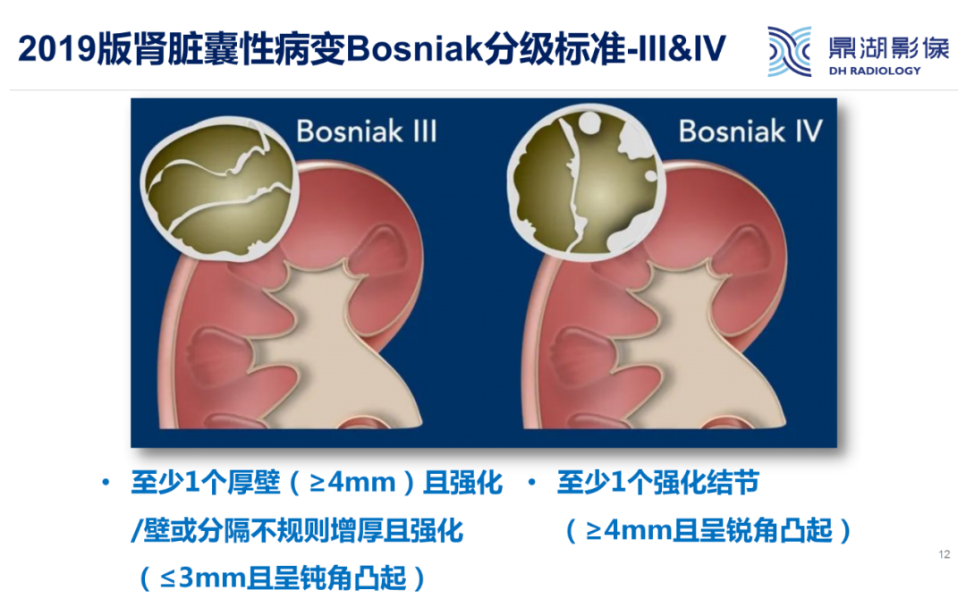 影像PPT - 【PPT】肾脏囊性病变Bosniak分级-12 影像PPT - 【PPT】肾脏囊性病变Bosniak分级-12