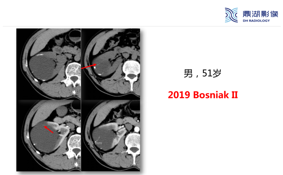 影像PPT - 【PPT】肾脏囊性病变Bosniak分级-17 影像PPT - 【PPT】肾脏囊性病变Bosniak分级-17