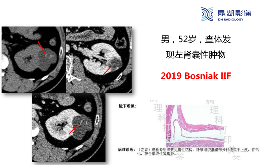 影像PPT - 【PPT】肾脏囊性病变Bosniak分级-19 影像PPT - 【PPT】肾脏囊性病变Bosniak分级-19