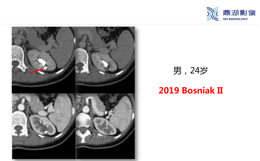 影像PPT - 【PPT】肾脏囊性病变Bosniak分级-18 影像PPT - 【PPT】肾脏囊性病变Bosniak分级-18