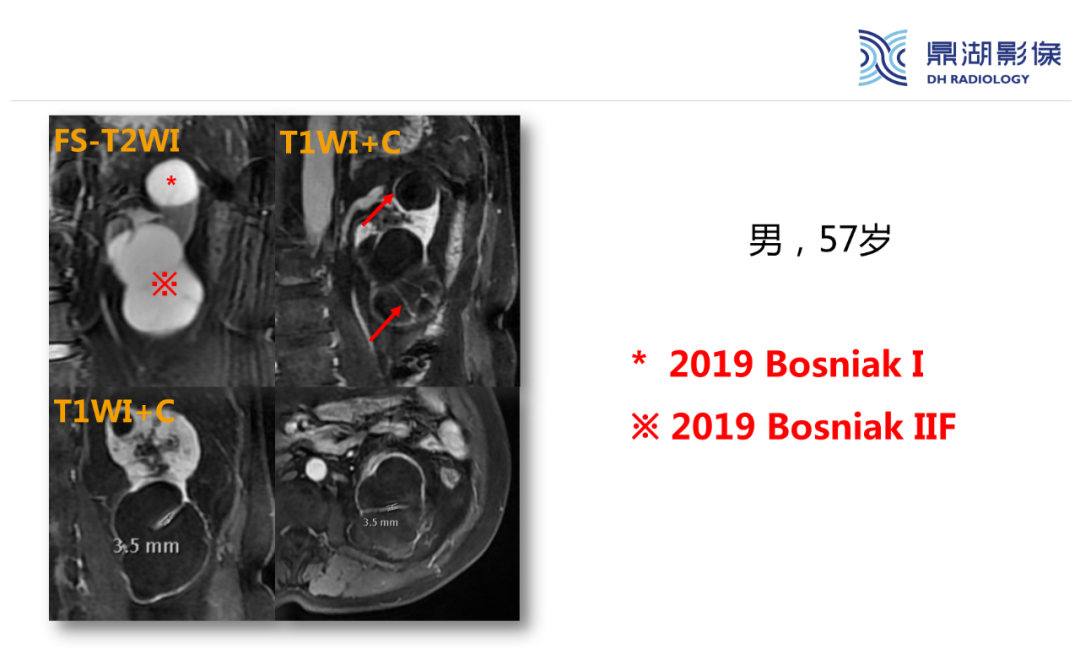 影像PPT - 【PPT】肾脏囊性病变Bosniak分级-20 影像PPT - 【PPT】肾脏囊性病变Bosniak分级-20