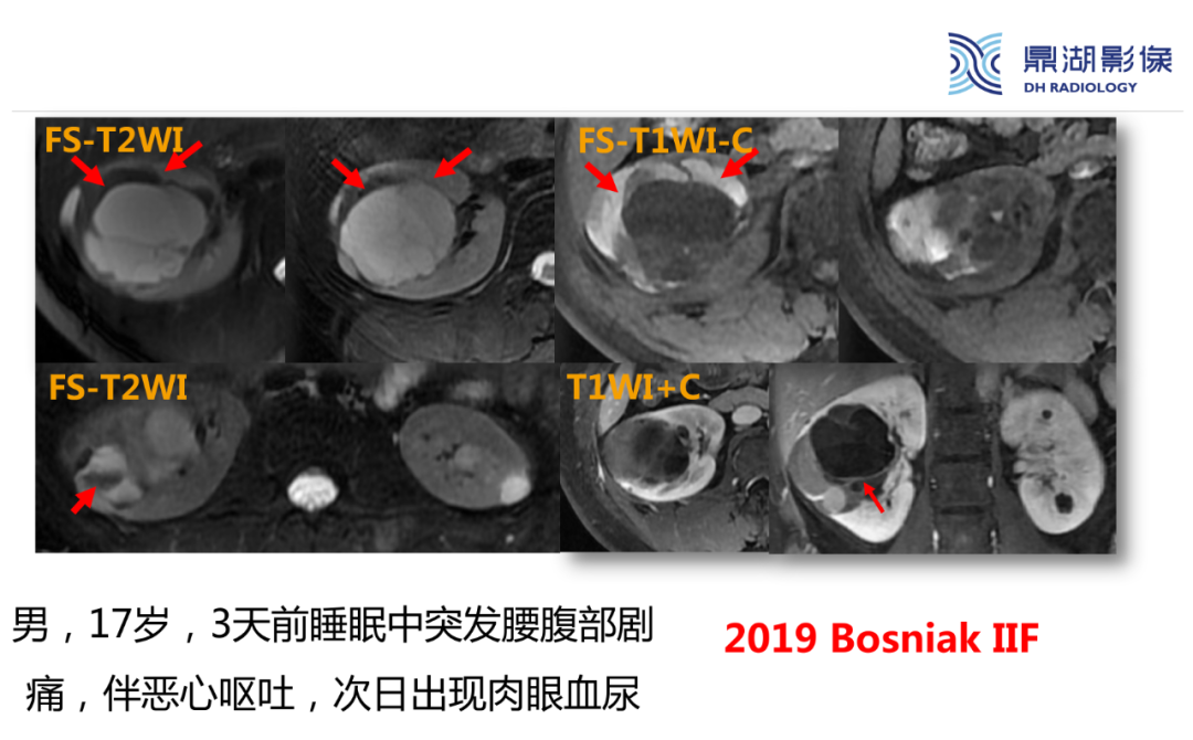 影像PPT - 【PPT】肾脏囊性病变Bosniak分级-23 影像PPT - 【PPT】肾脏囊性病变Bosniak分级-23