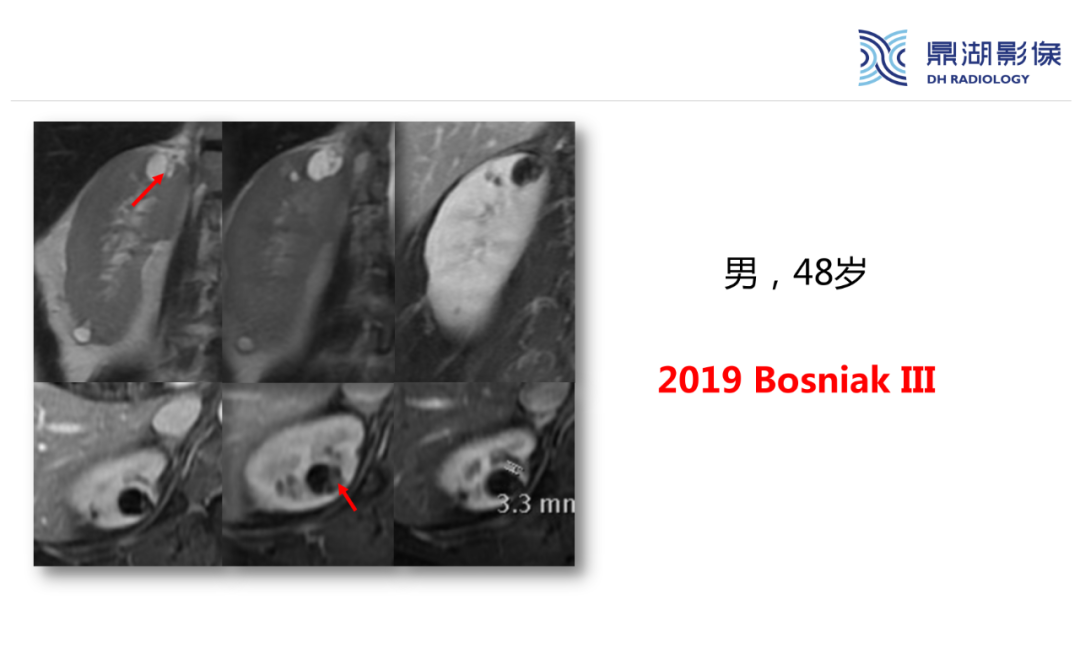 影像PPT - 【PPT】肾脏囊性病变Bosniak分级-22 影像PPT - 【PPT】肾脏囊性病变Bosniak分级-22