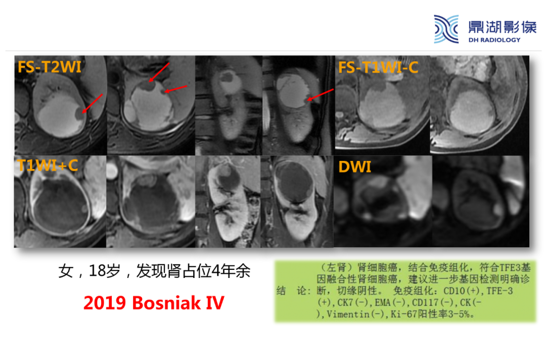 影像PPT - 【PPT】肾脏囊性病变Bosniak分级-27 影像PPT - 【PPT】肾脏囊性病变Bosniak分级-27