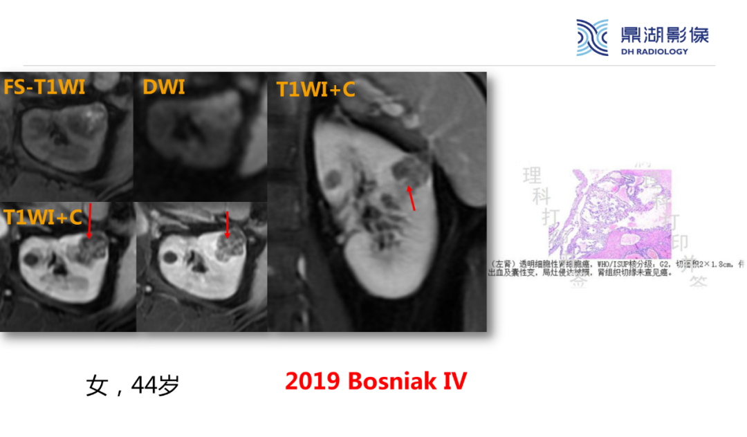 影像PPT - 【PPT】肾脏囊性病变Bosniak分级-28 影像PPT - 【PPT】肾脏囊性病变Bosniak分级-28