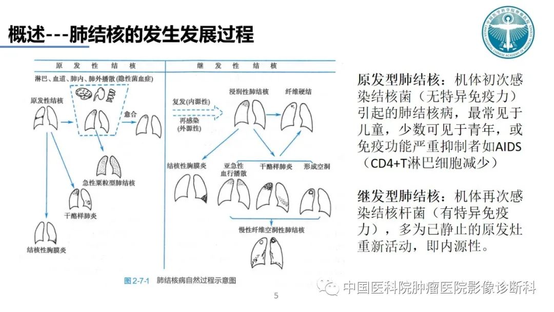 影像PPT - 【PPT】肺结核-5