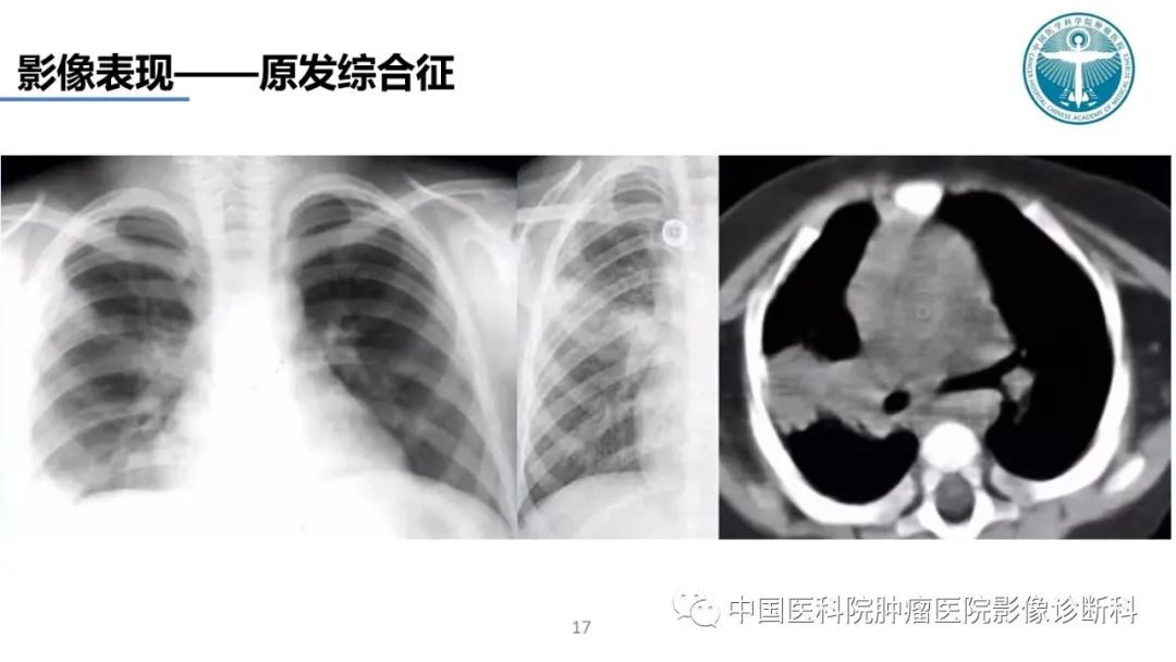 影像PPT - 【PPT】肺结核-17