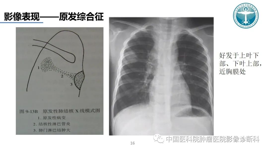 影像PPT - 【PPT】肺结核-16