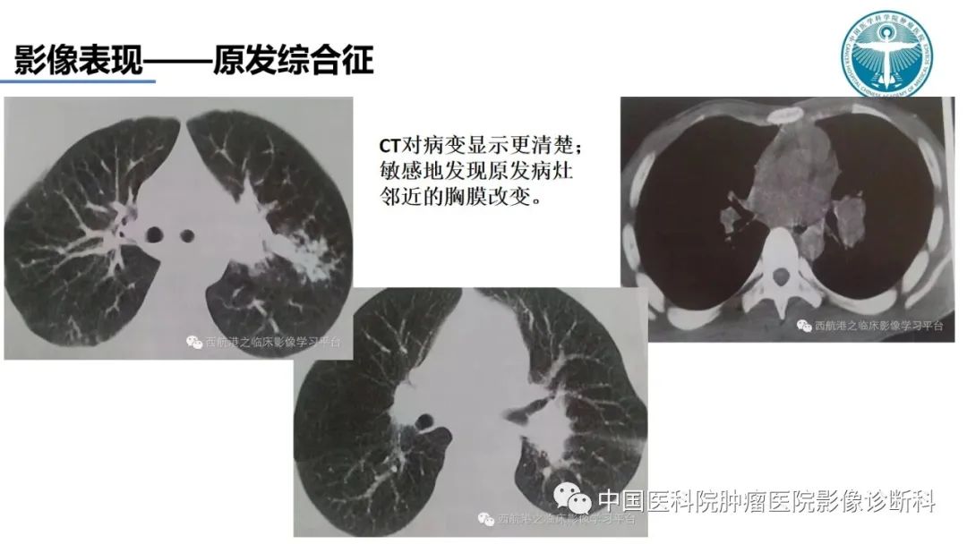 影像PPT - 【PPT】肺结核-18