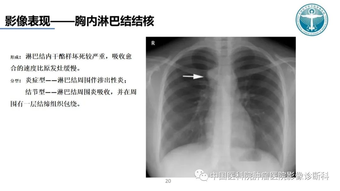 影像PPT - 【PPT】肺结核-20