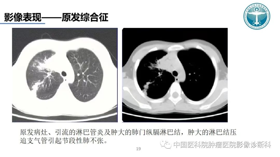 影像PPT - 【PPT】肺结核-19