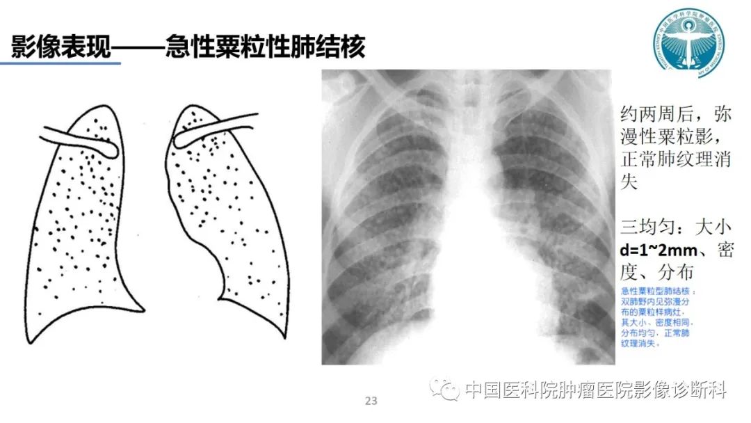 影像PPT - 【PPT】肺结核-23