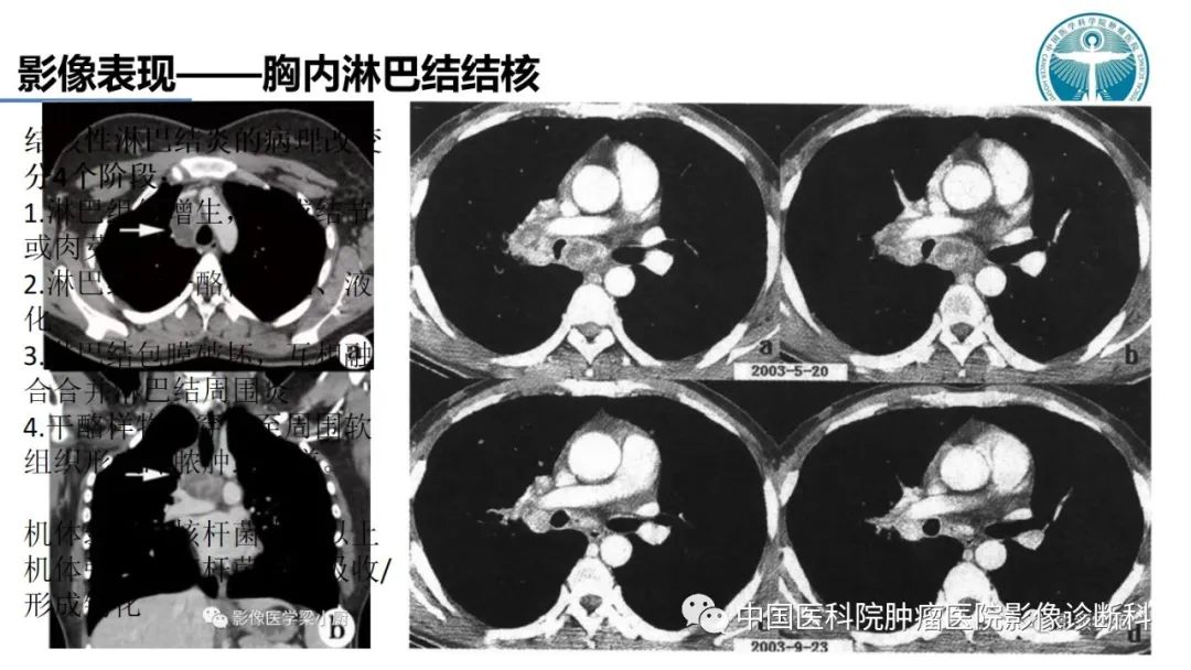 影像PPT - 【PPT】肺结核-21