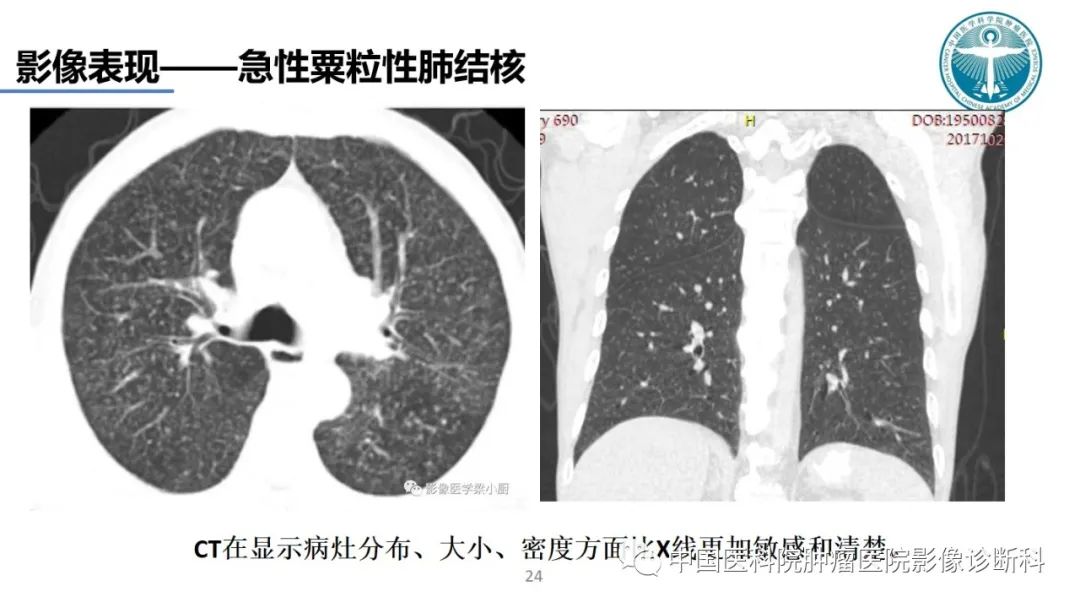 影像PPT - 【PPT】肺结核-24
