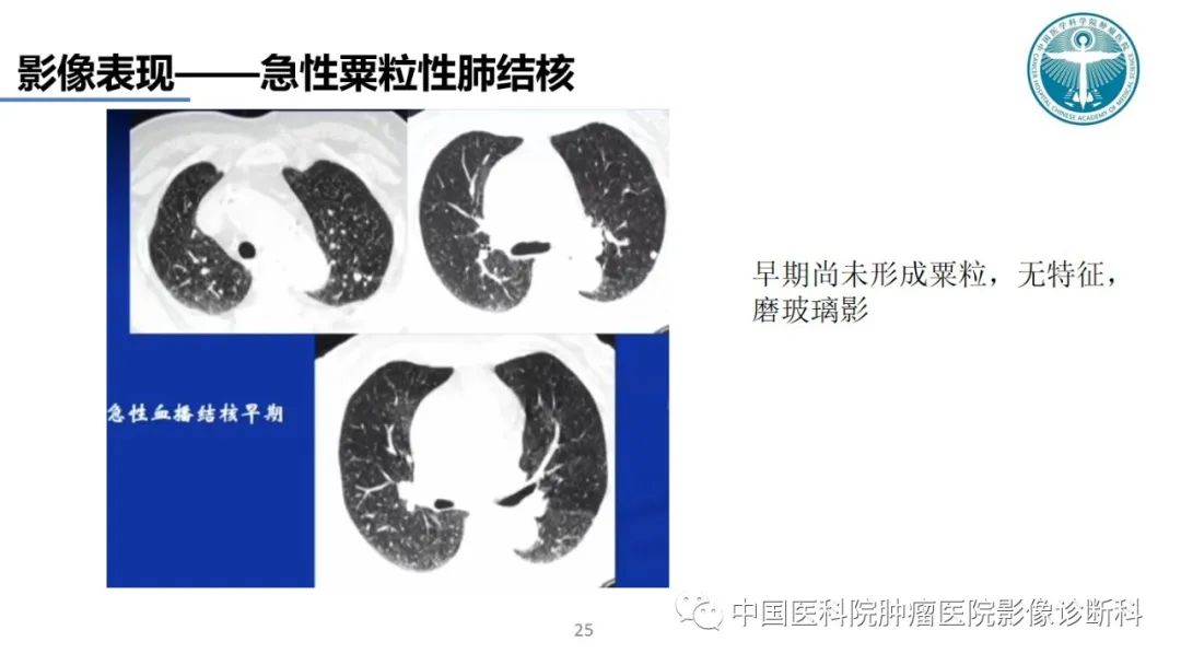 影像PPT - 【PPT】肺结核-25