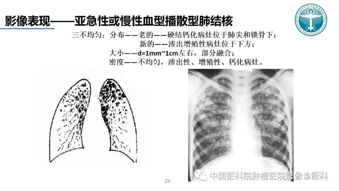 影像PPT - 【PPT】肺结核-26