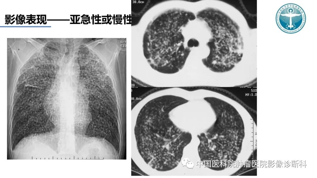 影像PPT - 【PPT】肺结核-27