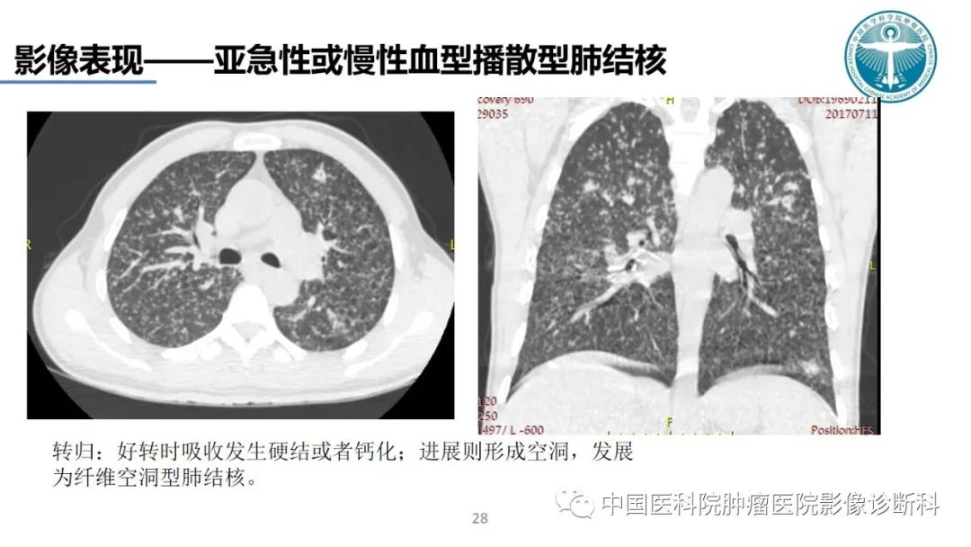 影像PPT - 【PPT】肺结核-28