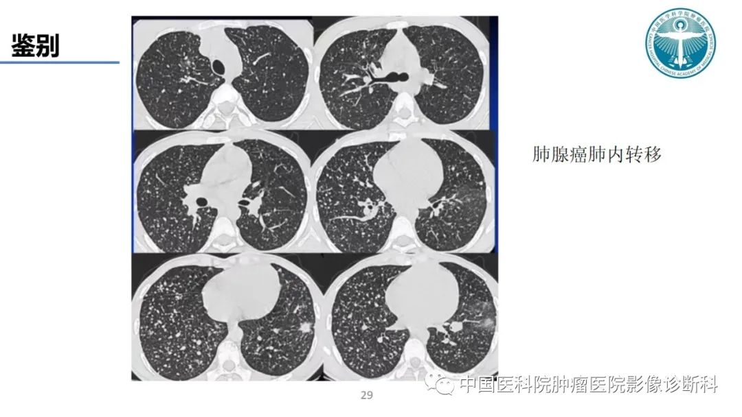 影像PPT - 【PPT】肺结核-29