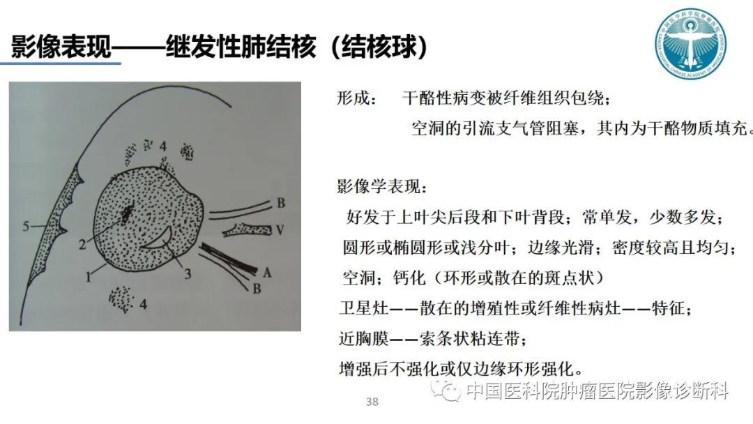 影像PPT - 【PPT】肺结核-38