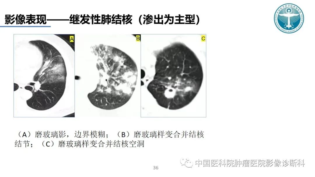影像PPT - 【PPT】肺结核-36