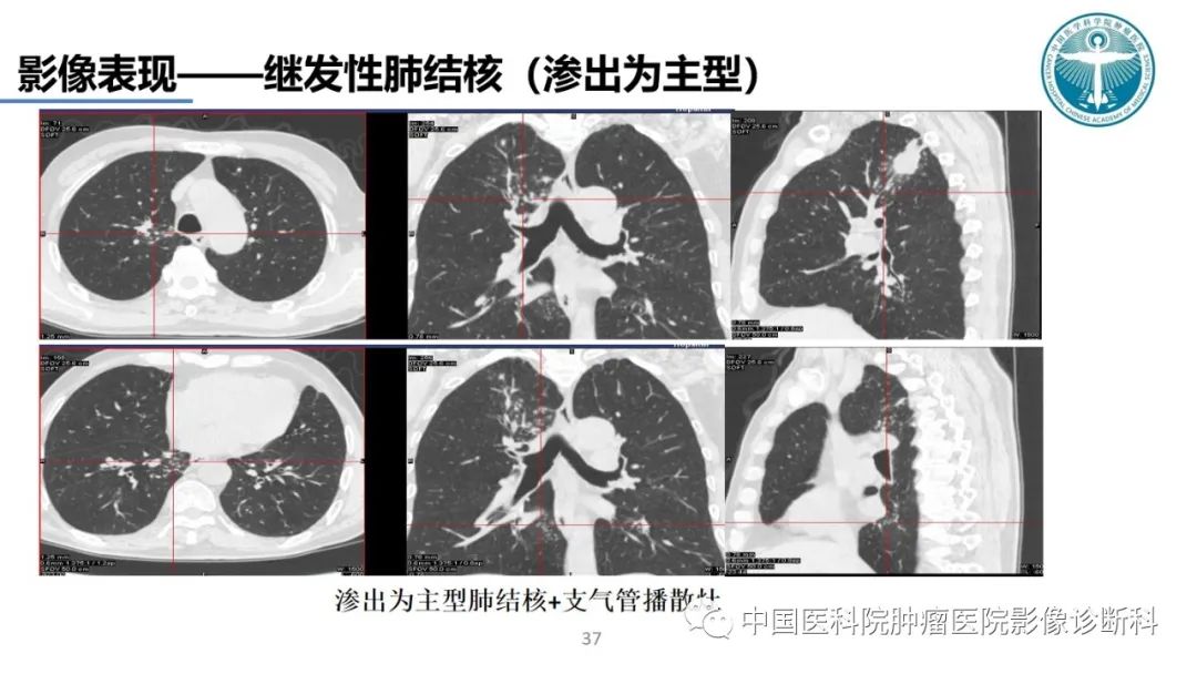 影像PPT - 【PPT】肺结核-37
