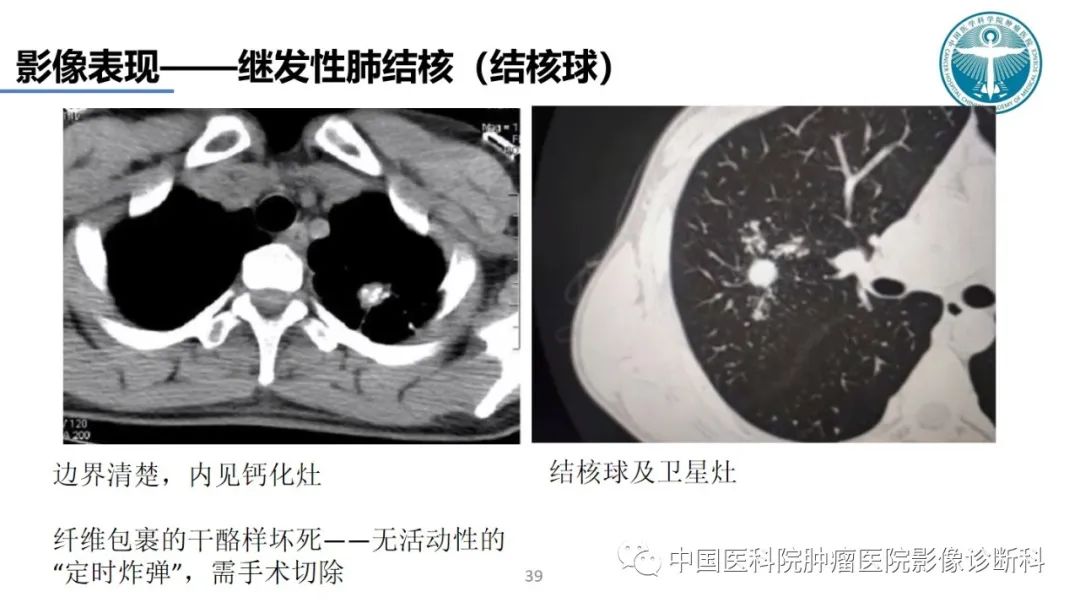 影像PPT - 【PPT】肺结核-39
