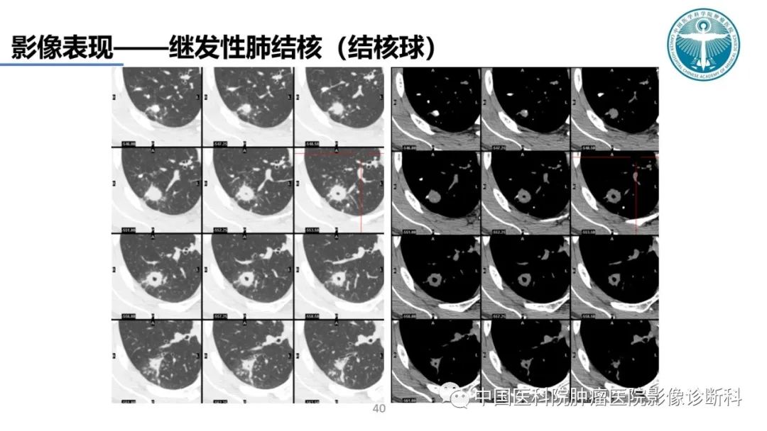 影像PPT - 【PPT】肺结核-40