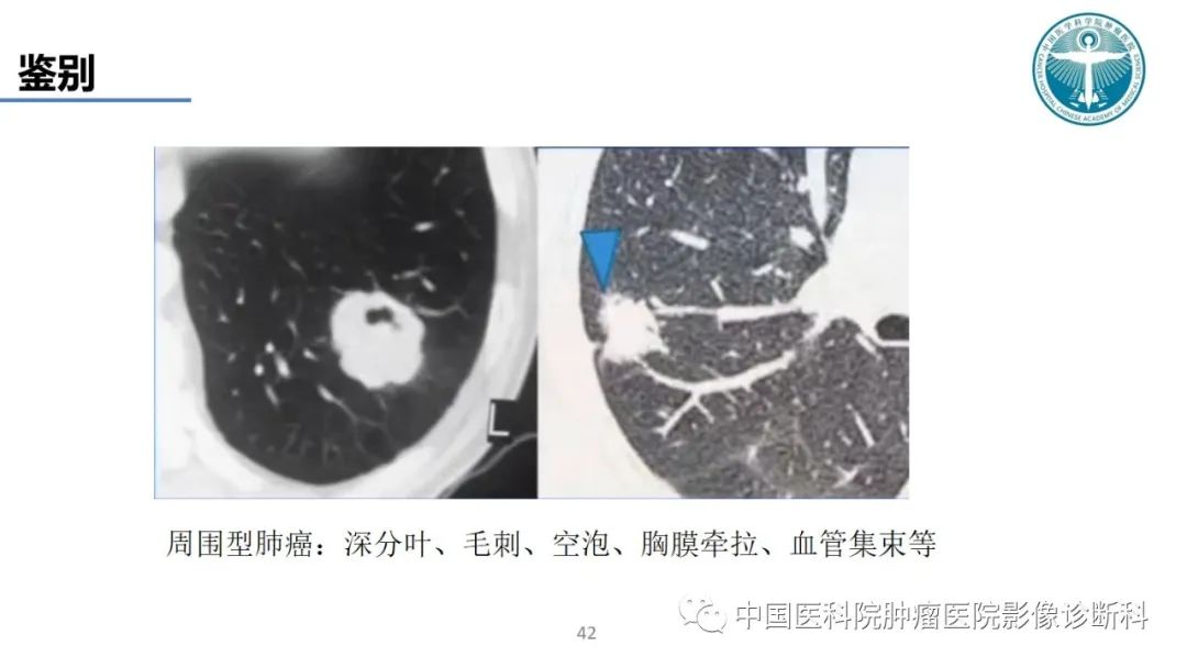 影像PPT - 【PPT】肺结核-42