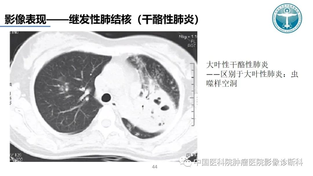 影像PPT - 【PPT】肺结核-44