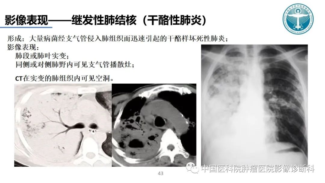 影像PPT - 【PPT】肺结核-43