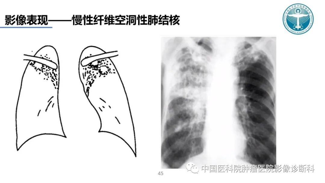 影像PPT - 【PPT】肺结核-45