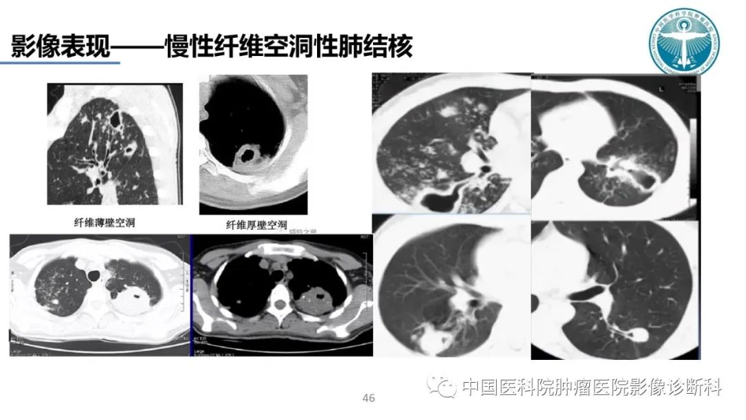 影像PPT - 【PPT】肺结核-46
