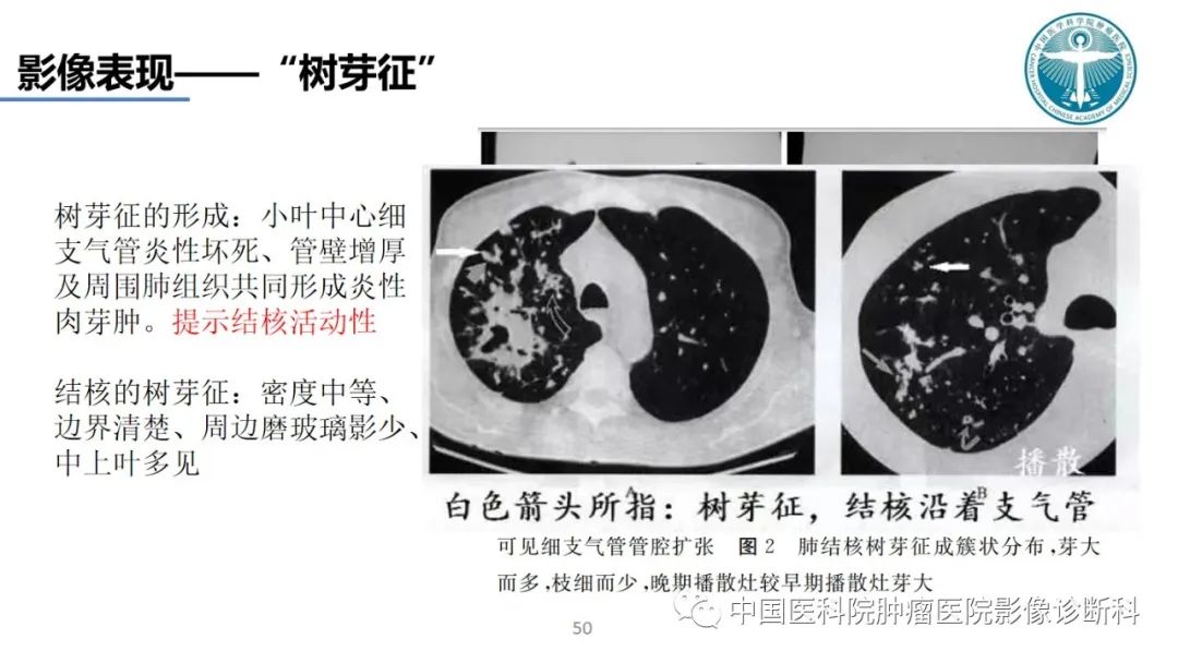 影像PPT - 【PPT】肺结核-50