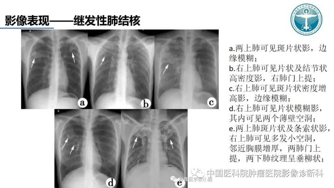 影像PPT - 【PPT】肺结核-48