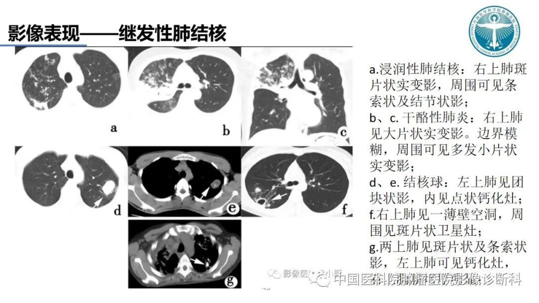 影像PPT - 【PPT】肺结核-49