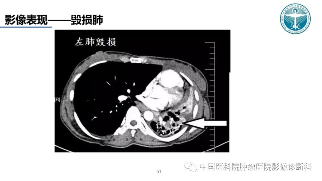 影像PPT - 【PPT】肺结核-51